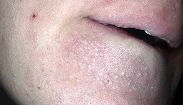 Причины и симптомы воспаления сальных желез на лице
