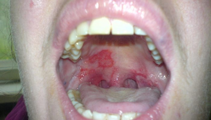 Почему на внутренней стороне губы или десне появился пузырь? Прозрачный, кровянистый и другие