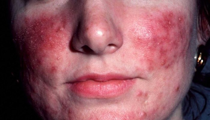 Розацеаподобный дерматит лица: лечение