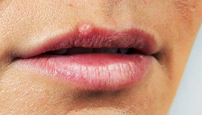Как избавиться от бородавки на губе? Проверенные методы традиционного и народного лечения