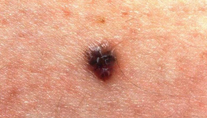 Узловая меланома кожи: лечение