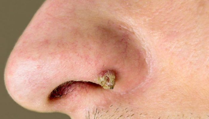 Почему образуются папилломы в носу? Симптомы, диагностика и лечение болезни