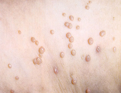 Сыпь в виде одиночных или множественных узелков при вирусном заболевании контагиозным моллюском