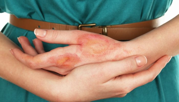 Первая помощь при ожоге уксусной эссенцией на коже и дальнейшее лечение