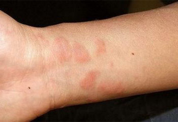 Аллергия на руках в виде красных пятен