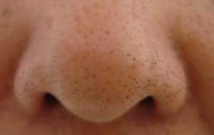 Появление черных точек на носу