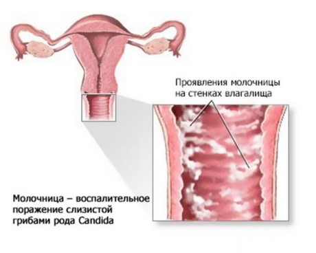 Кандидозы у женщин: причины возникновения и симптомы