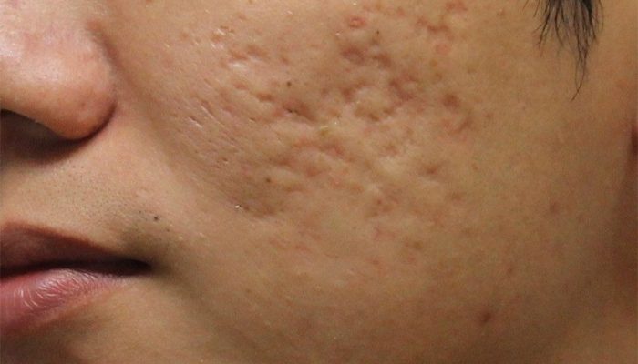 Почему на лице неровная кожа и как избавиться от бугристости? Процедуры и домашние средства