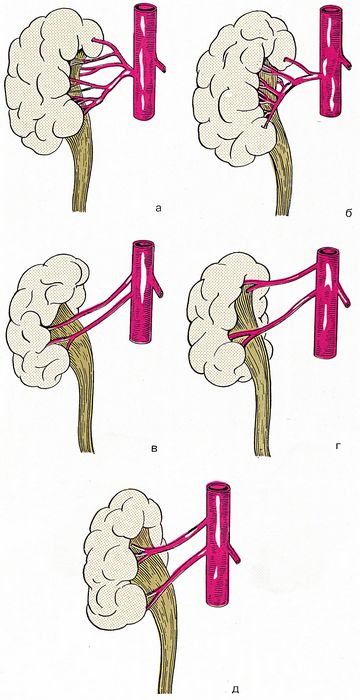 Различные формы ветвления почечной артерии