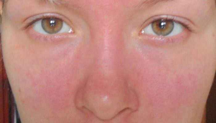 Аллергия на дегтярное, хозяйственное и детское мыло: симптомы