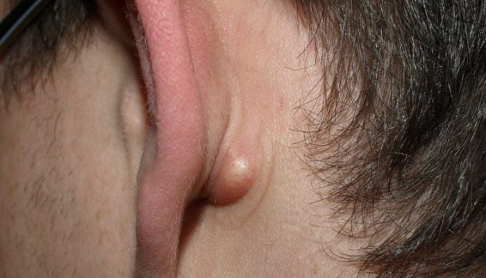 Как выглядит и почему появляется жировик за ухом или в мочке? Симптомы и методы лечения