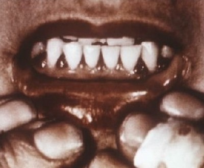 Зубы при болезни Меллера-Барлоу