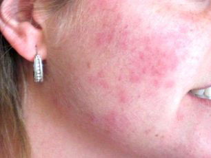 Красные пятнышки, возникшие на лице вследствие кожных заболеваний