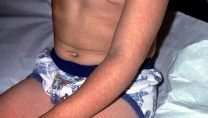 Инфекционная эритема у детей и у взрослых