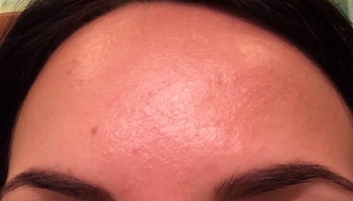 Как предотвратить и лечить аллергию на краску для волос? Простое решение частых проблем