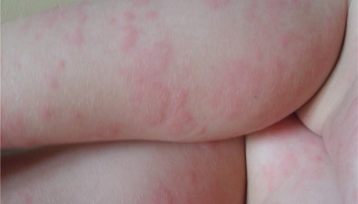 Аллергия на картофель у ребенка