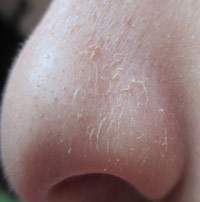 Почему шелушится кожа на носу и вокруг