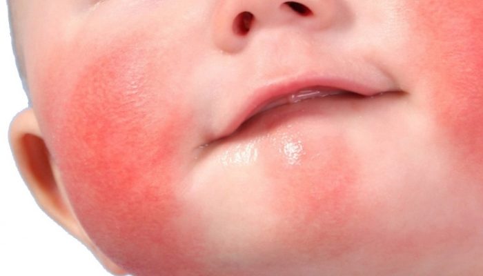 Диатез у детей: аллергический, нейро-артритический и шизотипический