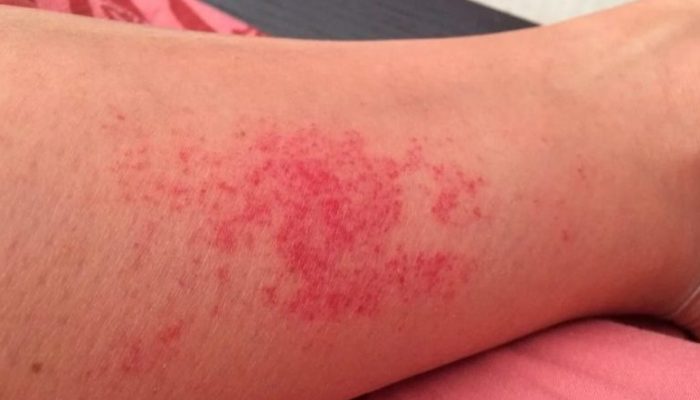 Что за болезнь кожный васкулит и как ее лечить? Мнения специалистов