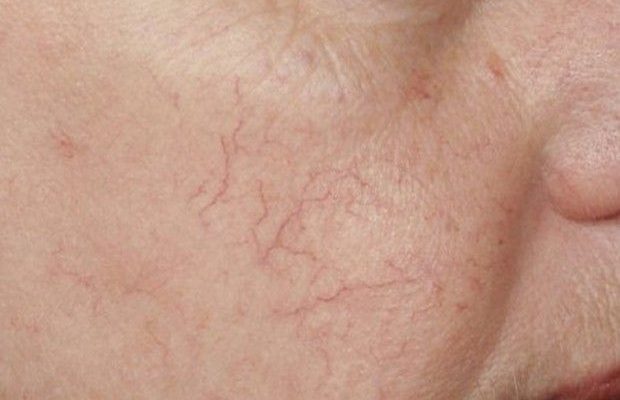 Пятна и другие симптомы болезней печени на коже: как поставить диагноз?