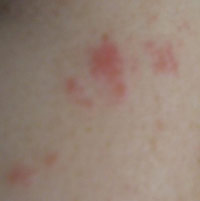 Раздражение на коже – симптом различных заболеваний, проявляющийся в виде воспаления и покраснения.