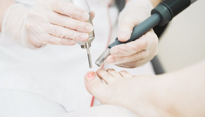 Подробно о лечении грибка ногтей лазером: эффективность, преимущества и противопоказания