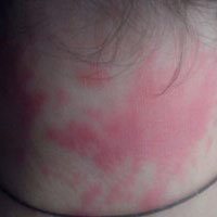 Возникла аллергия и появились пятна на шее красного цвета