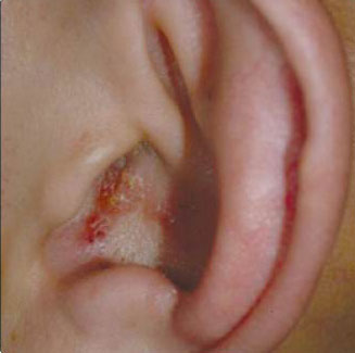 Причины и лечение народными средствами зуда в ушах