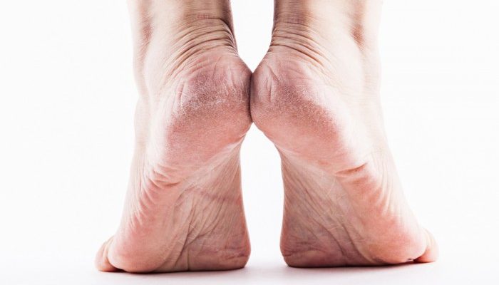 Беспокоит сухая кожа на ногах? Основные причины, симптомы, а также эффективные способы лечения шелушения и трещин