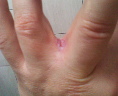 Причины возникновения сухости и шелушения между пальцами рук