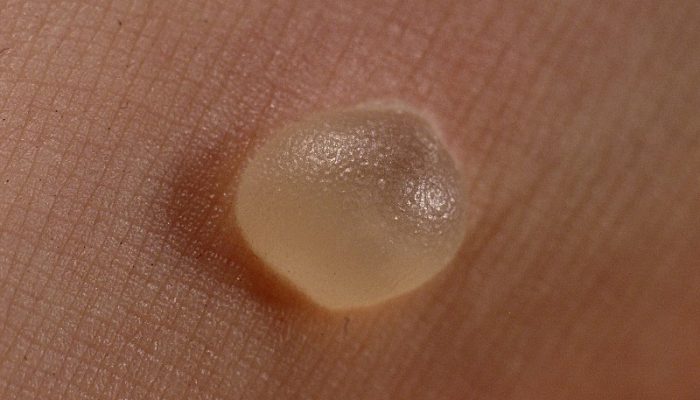 Пузырьки на коже чешутся водяные пузырьки на руках фото лечение