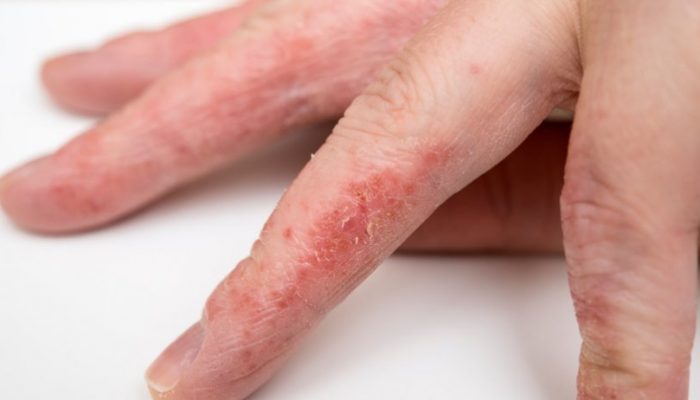Как проявляется аллергия на латекс?