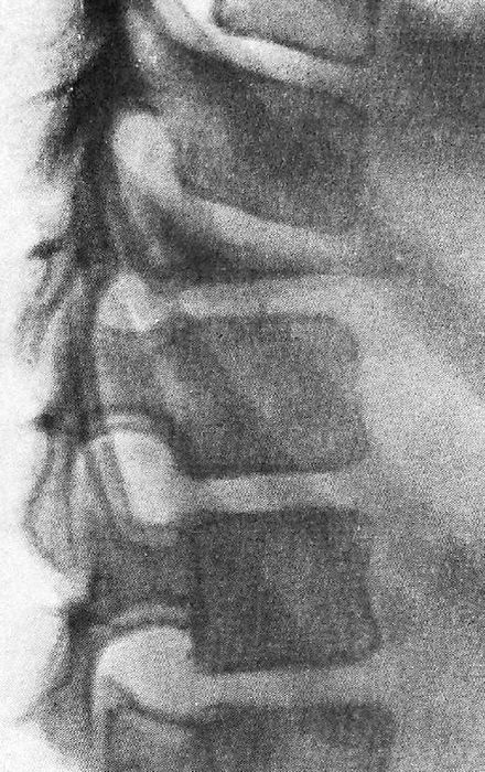 Болезнь Кальве (фото рентгенограммы)