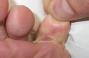 Зуд кожи под пальцем и покраснение, как результат заражения грибковыми инфекциями