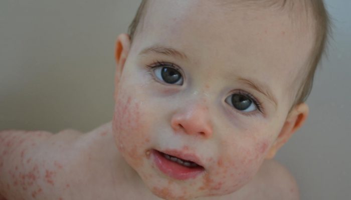 Гнойничковые заболевания кожи (пиодермия) у детей