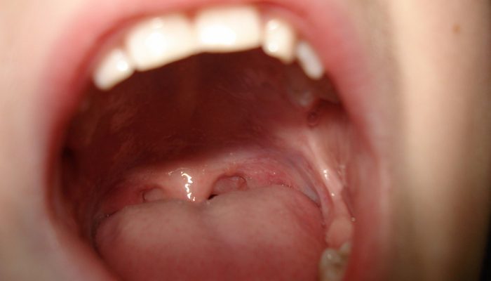 Хламидиоз горла: симптомы, инкубационный период