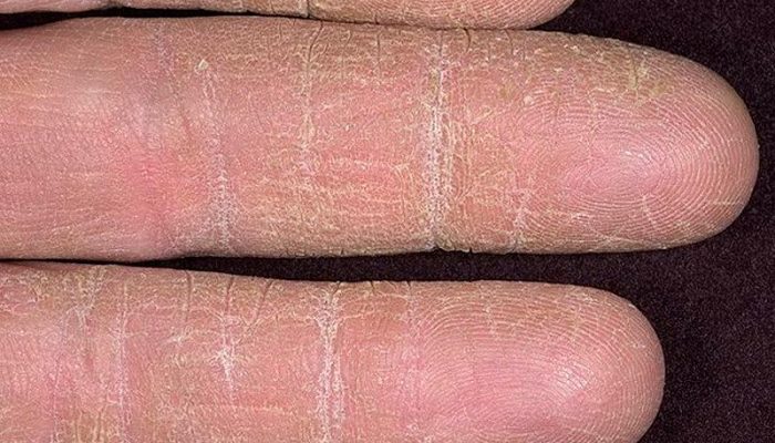 Что такое дерматофития гладкой кожи и ногтей? Симптомы и лечение