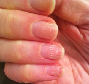 Признаки грибка на ногтях рук (с фото)