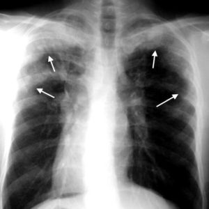 Инфильтраты Леффлера на рентгеновском снимке при аскаридозе