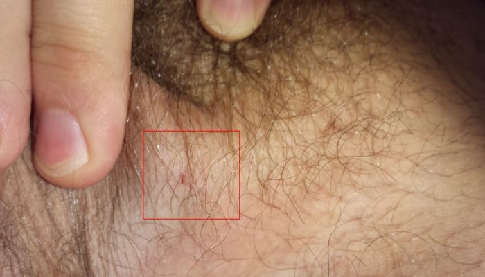 Бородавки на гениталиях: лечение у женщин и мужчин