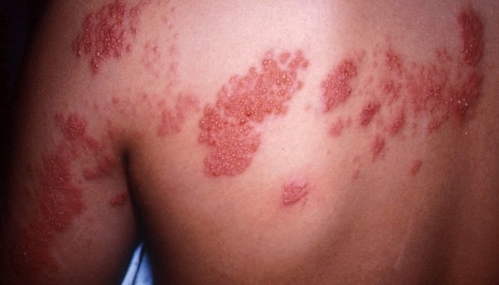 Что такое буллезный дерматит? Причины возникновения пузырьковых высыпаний на коже и методы лечения булл