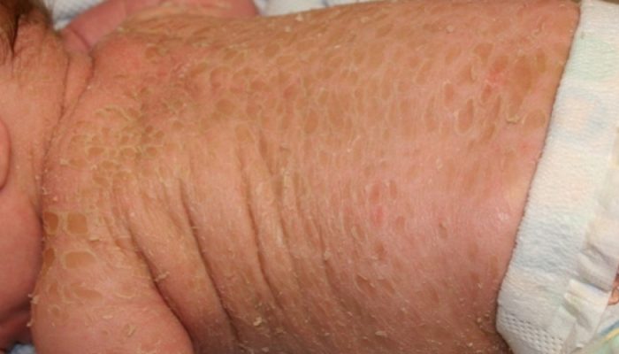 Что такое ихтиоз кожи и ихтиоз Арлекина? Причины, симптомы и лечение болезни