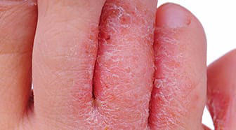Чешуйчатая кожа на ногах возникает при заражении грибковой инфекцией
