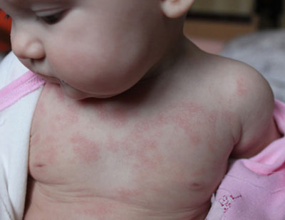 Аллергический дерматит приводит к появлению красных пятен на теле у ребенка.