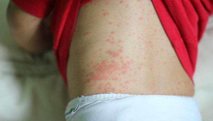Как выглядит и лечится аллергия на нервной почве?