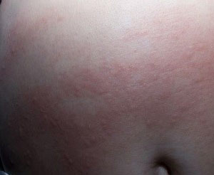 Аллергия на теле в виде красных пятен