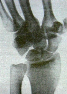Свежий перелом в проксимальной трети ладьевидной кости