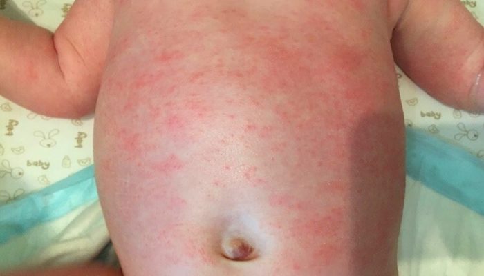 Как выглядит аллергия на порошок у ребенка? Способы лечения и профилактики