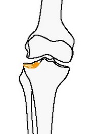Неполный внутрисуставной вдавленный перелом большеберцовой или малоберцовой костей