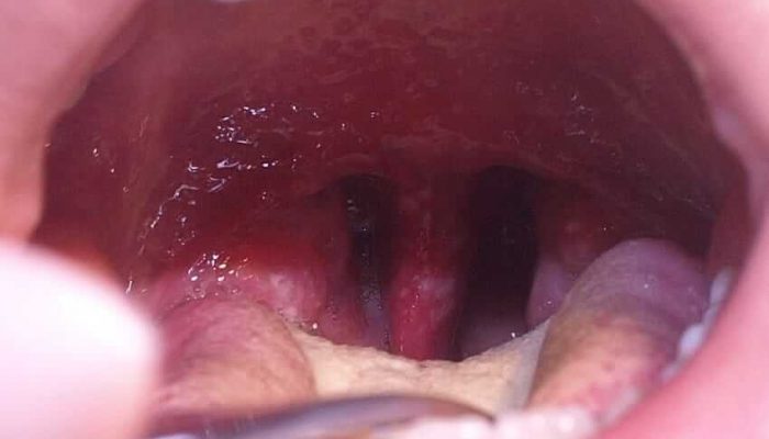 Хламидиоз горла: симптомы, инкубационный период